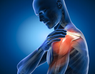 Painful shoulder joints. Frozen shoulder, Impingement. 3d illustration - obrazy, fototapety, plakaty