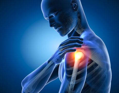 Painful shoulder joints. Frozen shoulder, Impingement. 3d illustration