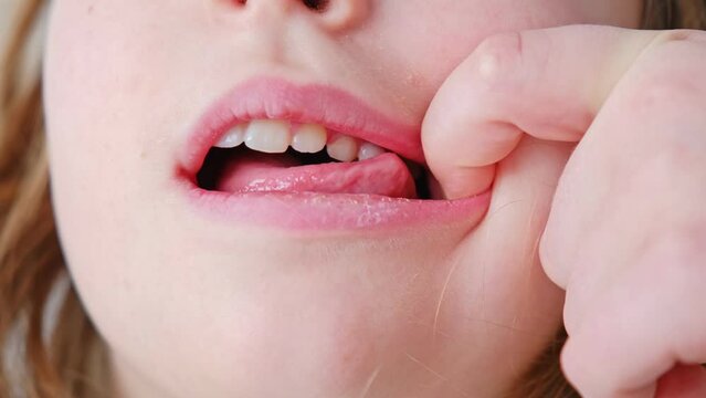 Caucasian Girl Pushing Loose Primary Deciduous Baby Tooth With Tongue