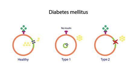 Diabetes mellitus type 1, pancreas's failure to produce enough insulin and type 2, cells fail to respond to insulin (Insulin resistance). Result in high blood glucose levels. Vector illustration.