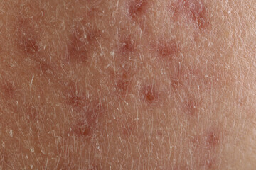 Texture of skin with acne problem as background, macro view