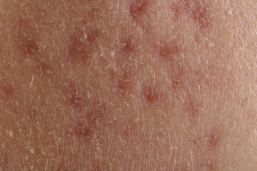 Fototapeta premium Texture of skin with acne problem as background, macro view