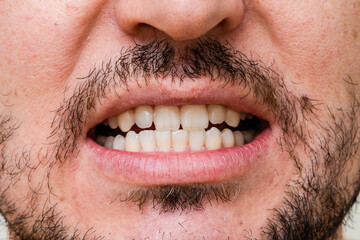 Closeup young man with beautiful smile. Teeth whitening, teeth straightening, fresh breath