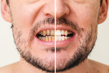 Man's teeth before and after whitening and alignment (braces). Oral care - obrazy, fototapety, plakaty