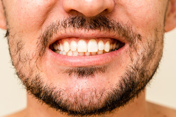 Obraz premium Close up of man's teeth before and after whitening and correction (braces, alignment). Oral care