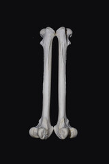 Exostosis on bones