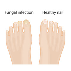 Obraz premium Nail diseases. Onychomycosis, causes of fungal nail infection. Medical infographic design