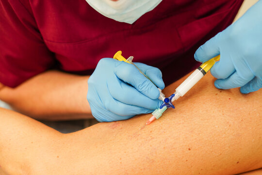 Removal of varicose veins on the legs. Doctor doing sclerotherapy