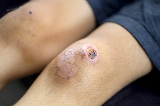 open wound on the knee. injured due to accident. Wounds that tear skin tissue results in infection.