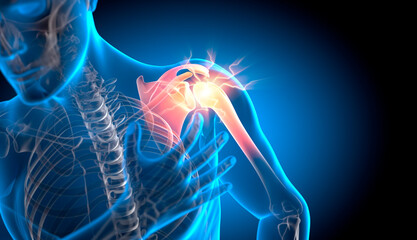 X-ray 3D Illustration of Pain in Shoulder Joint - 3D Illustration