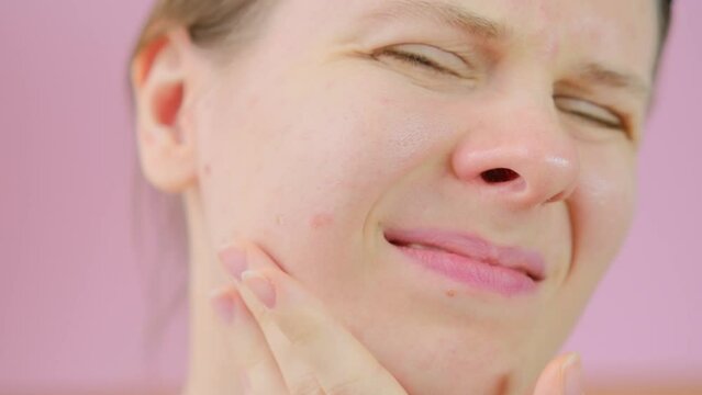 Woman is unhappy with the condition of her skin. Close up skin with acne, peeling and enlarged pores. Woman touching acne on her face. Skin problems, allergic, redness, pimples.