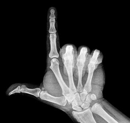 Film xray x-ray or radiograph of a thumb and finger in gestural language, manual communication, or signing aka sign language, pointing up this way or that way