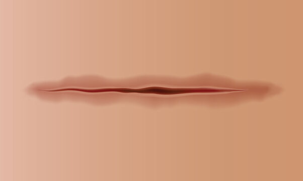Healing wounds, skin scar, stitched gash and cut. Realistic surgical suture, stitched wounds. Healing stage on human skin background. Vector illustration