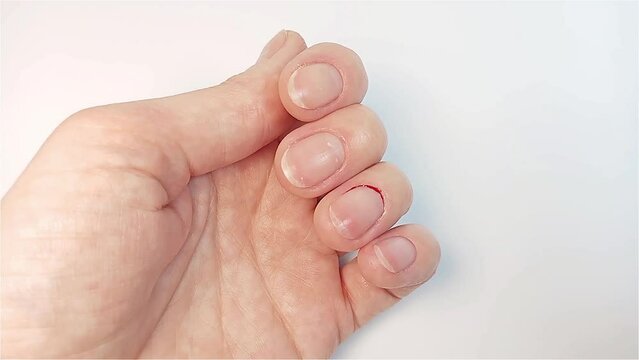 The woman treats the cuticle cut with an antiseptic and wipes it with a napkin, trying to stop the bleeding. Injuries in the process of manicure and cutting the cuticle