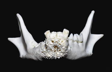 Neoplastic Bone Diseases