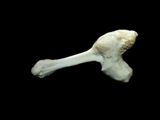 Fototapeta premium Hypertrophic osteoarthropathy (HOA)