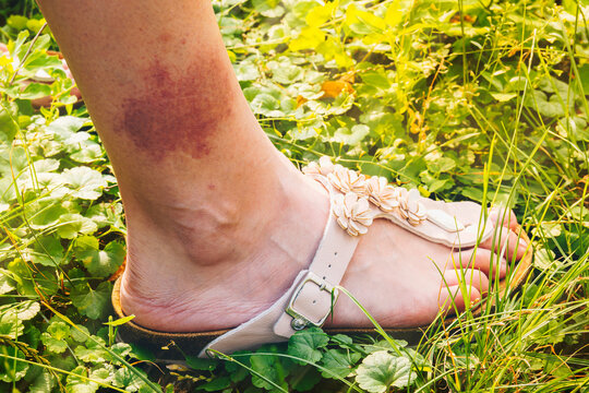 Lyme disease, borreliosis or borreliosis, typical Lyme rash, spots. A large red sore, a spot from a tick bite on a girls leg. Selective focus.