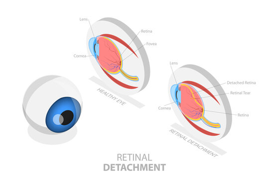 3D Isometric Flat  Conceptual Illustration of Retinal Detachment, Medical Educational Diagram