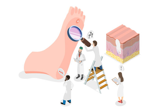 3D Isometric Flat  Conceptual Illustration of Foot Wart, Swollen Skin with Rough, Yellowing Patch