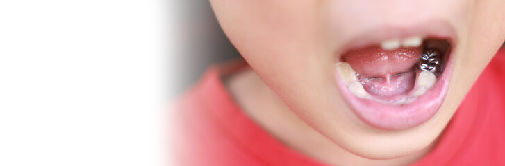Child milk teeth fall out from gum. little boy permanent tooth grows in mouth. Cute kid open her...