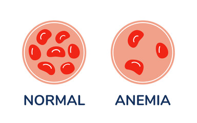 The difference comparison of a drop of blood with normal and anemic cells under microscope vector Medical illustration