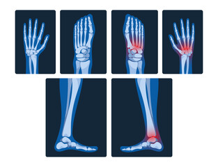 X-ray Pictures Of Hands And Legs Reveal Skeletal Structures, Joint Health, And Potential Abnormalities, Vector Set