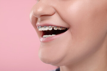 Smiling woman with dental braces on pink background, closeup. Space for text