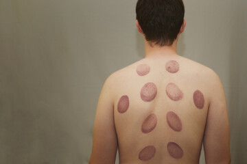 Back of a young man on a gray background with consequences of vacuum massage. Incorrect vacuum...