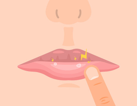 an illustration of the appearance of canker sores in the mouth. mouth sore and inflamed. feels sore because you have canker sores. oral health conditions. flat illustration design. graphic elements