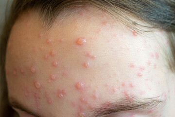 Natural vaccination. Contagious disease. Sick child with chickenpox.