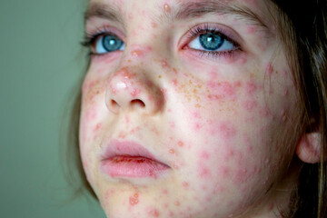 Natural vaccination. Contagious disease. Sick child with chickenpox.