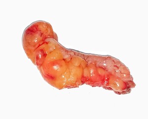 Appendix specimen from appendectomy, after surgery from the doctor.
