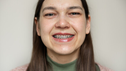 Metal braces on teeth. Orthodontic dental care concept. Woman's smile with braces. - obrazy, fototapety, plakaty