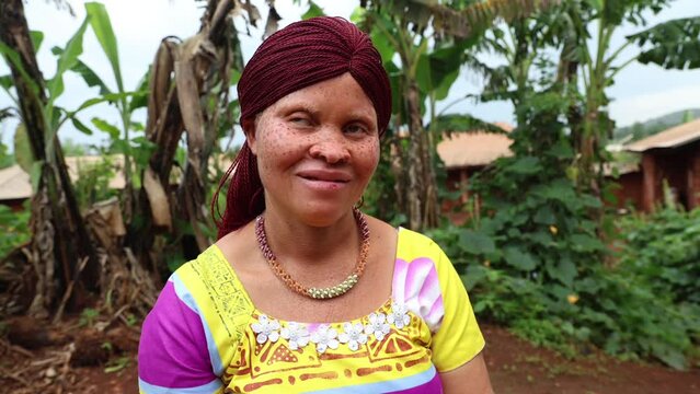 Close-up of an African albino woman sitting in a chair in the village

