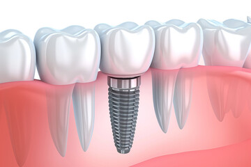 Closeup view of prosthetic dental implant and teeth.  - obrazy, fototapety, plakaty
