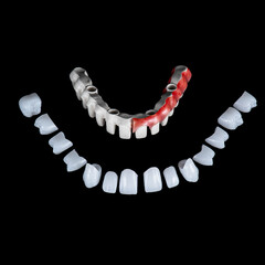 zircon bridge on 8 dental implants