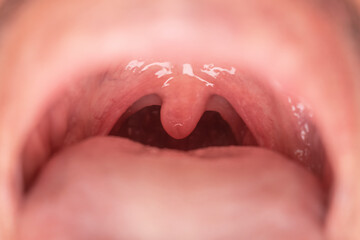 close up of man's open mouth with tonsils