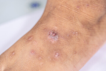 Fototapeta premium Atopic dermatitis (AD), also known as atopic eczema, is a type of inflammation of the skin (dermatitis).