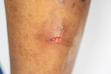 Atopic dermatitis (AD), also known as atopic eczema, is a type of inflammation of the skin...
