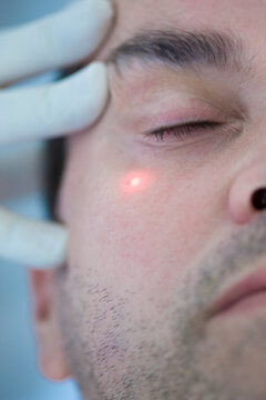 Man Receiving Laser Treatment on Face
