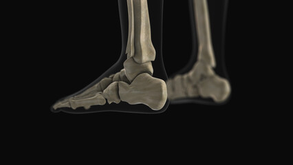 Medical animation of the calcaneus bone pain