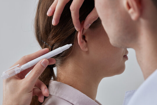Otoplasty markup for surgical reshaping of the pinna, or outer ear for correcting an irregularity and improving appearance. Surgeon doctor marking girl ear before otoplasty cosmetic surgery