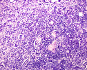 Human prostate cancer. Adenocarcinoma
