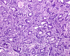 Human prostate cancer. Adenocarcinoma