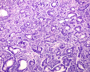 Human prostate cancer. Adenocarcinoma