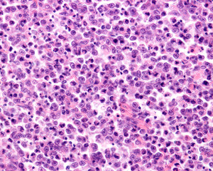 Human lymph node. Reticulosarcoma