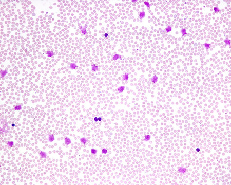 Blood smear. Chronic lymphocytic leukemia