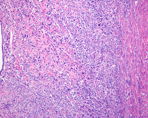 Obraz premium Human uterus. Sarcoma
