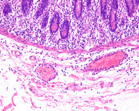 Inflammation. Leucocyte diapedesis