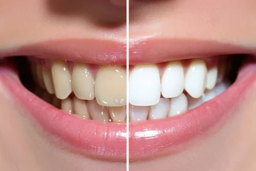 Fotobehang Teeth of a woman before and after whitening © Miquel